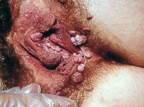 female genital warts