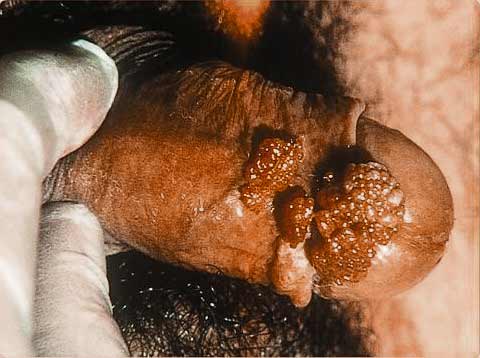 genital penis warts