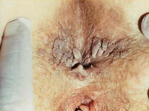 Anal warts