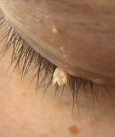 Filiform wart on a persons eyelid