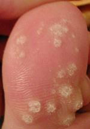 planters warts on feet. Plantar warts